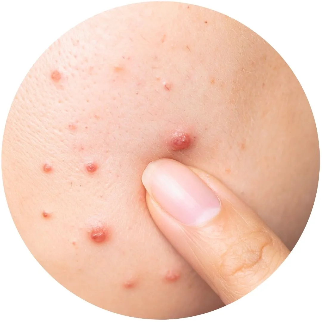 علاج حب الشباب